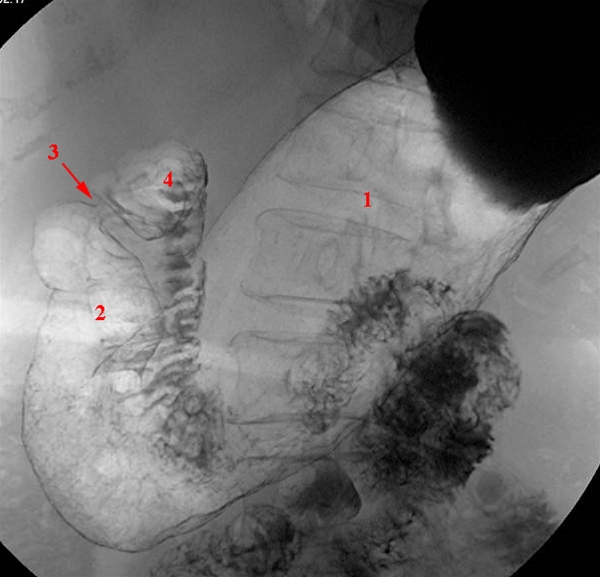 mavesaek-normal-liggende roentgen