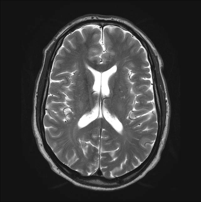 hjerne-normal hjerne 1-mr