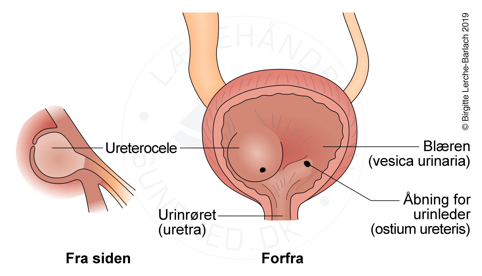 Ureterocele - urografi