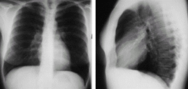lunger-lungeemboli-roentgen