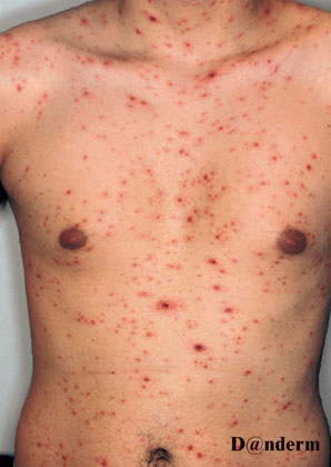 skoldkopper-overkrop