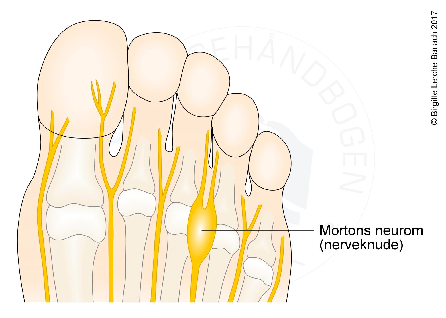 LH_2444_Mortons metatarsalg