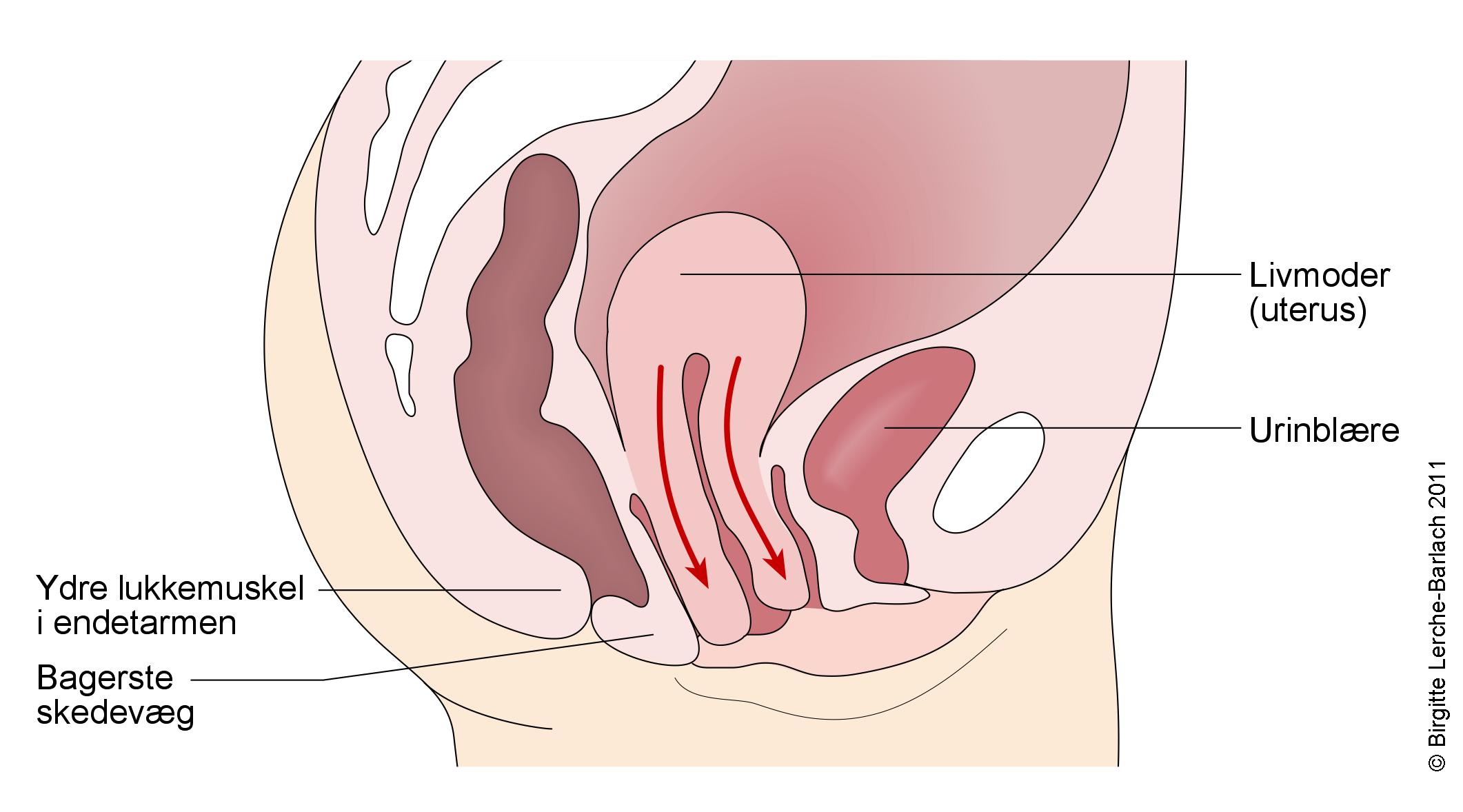 livmoder-uterusdescens til introitus