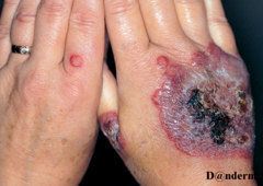 Foto af pyoderma gangrenosum på hænderne