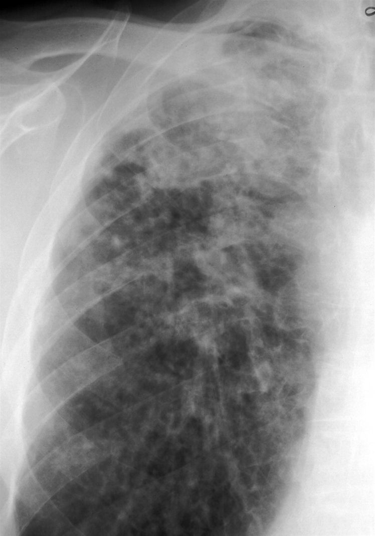 lunger-silikose-roentgen