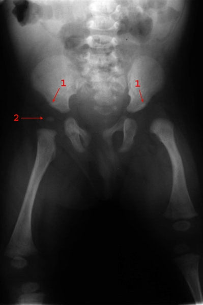 hofte-hofteledsdysplasi-roentgen