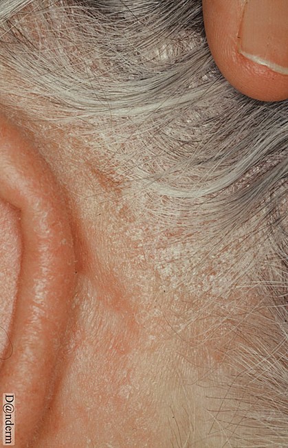 seboroisk eksem - haarbund Danderm