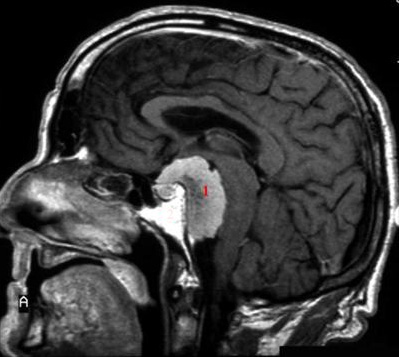 hjerne-meningeom med kontrast-mr
