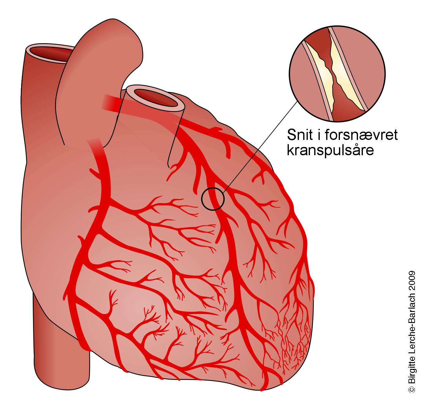 aarer-kranspulsaare forsnaevring