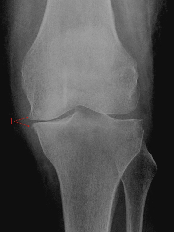knae-gonartrose-gigt-moderat front-rtg
