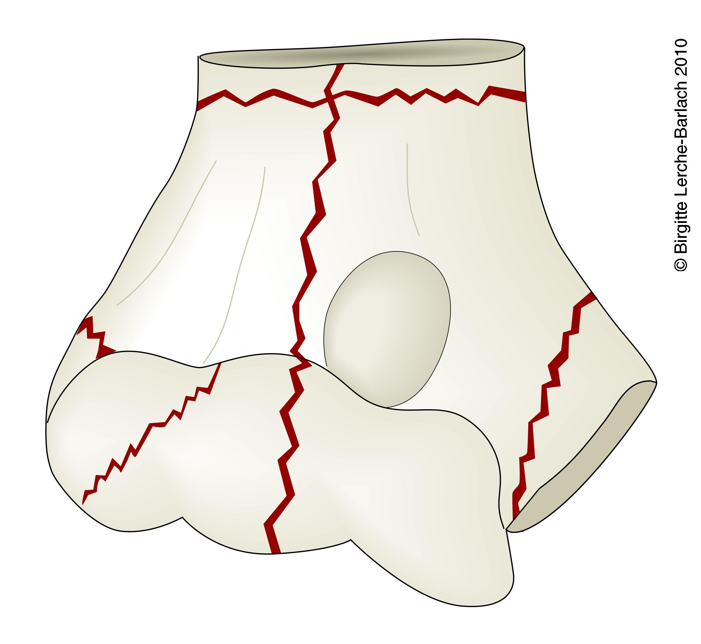 arm-humerus distale frakturer