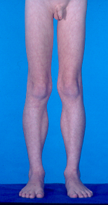 Duchenne UE forfra bmp