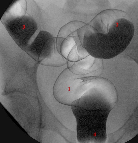 colon-oversigt rektosigmoideum-roentgen