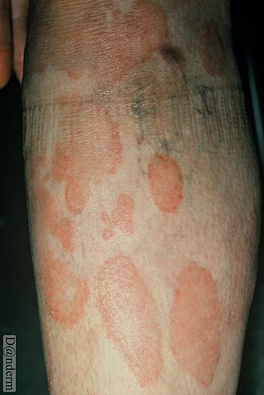 mycosis fungoides