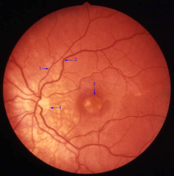 oeje-makuladegeneration