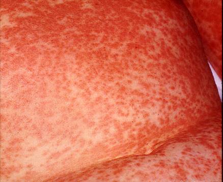 hud-ampicillinudslaet hos patient med infektioes mononukleose