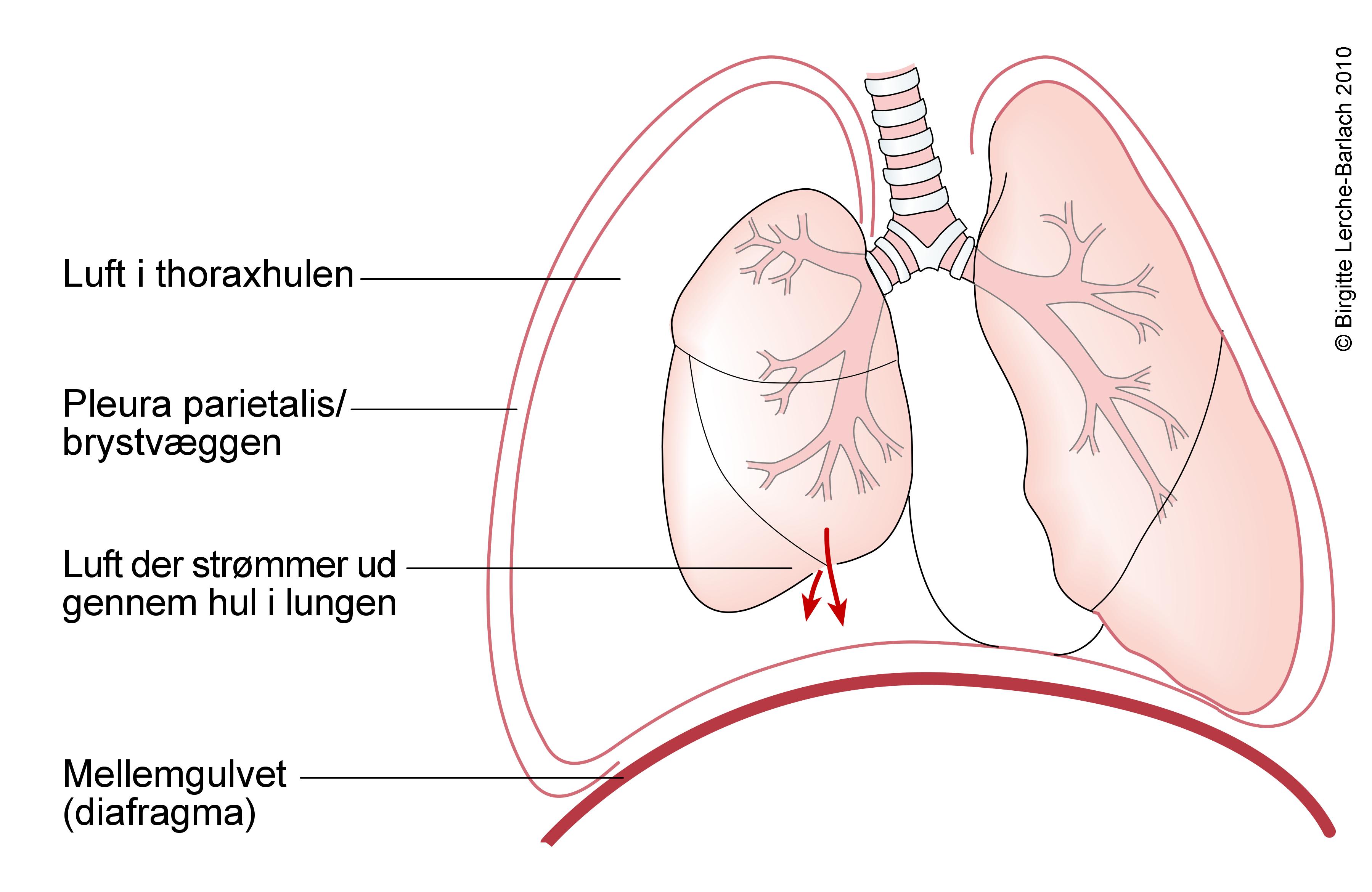lunge-pneumothorax ventil