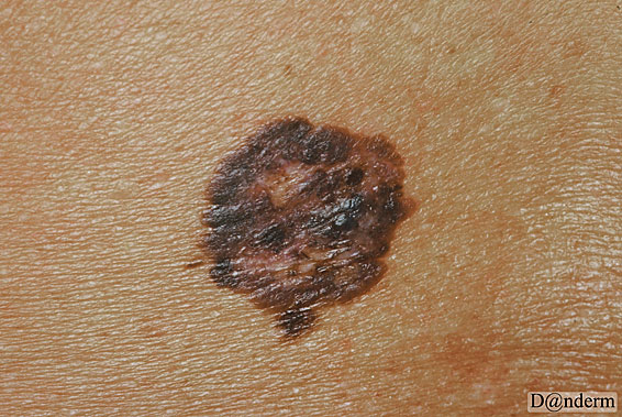 malignant melanoma superficiel spredning