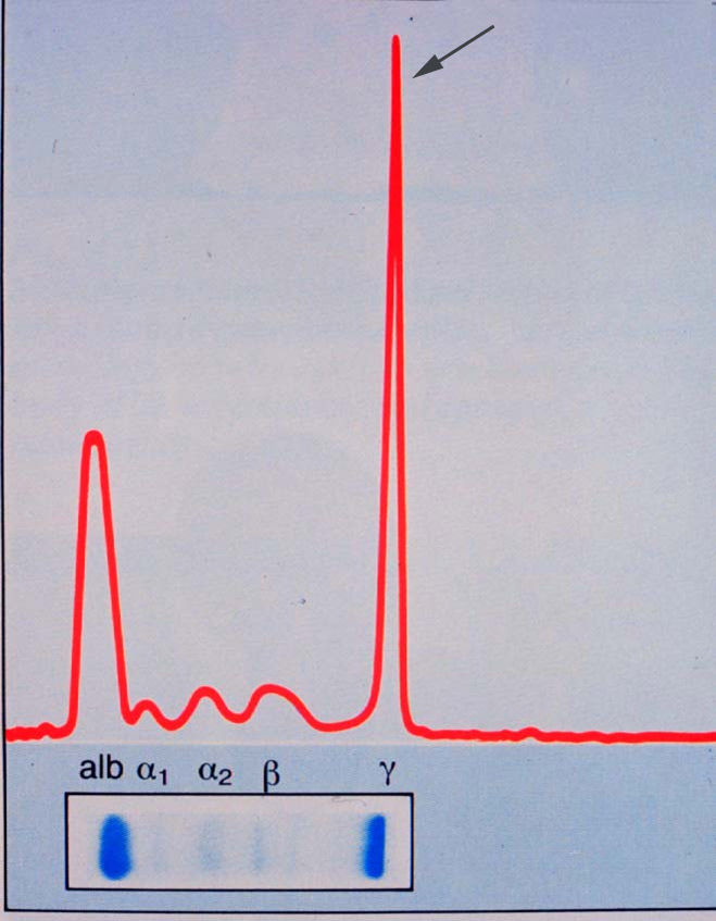 serum elektroforese med m komponent jpg