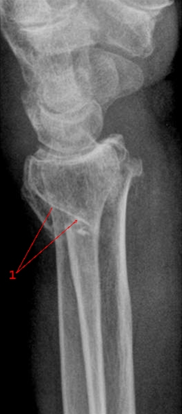 radius-fraktur-side-roentgen