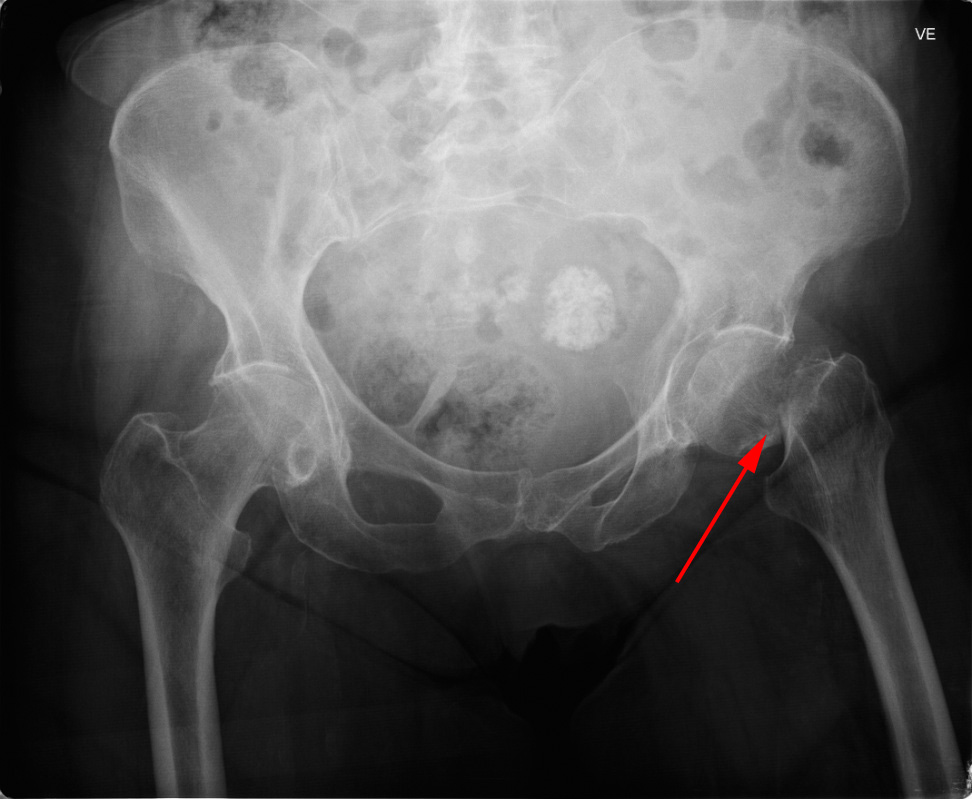 hofte-fraktur-roentgen