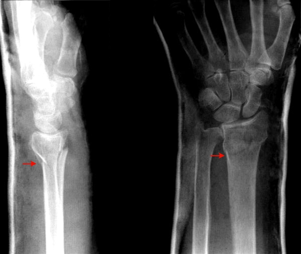 radius-fraktur-roentgen-haand