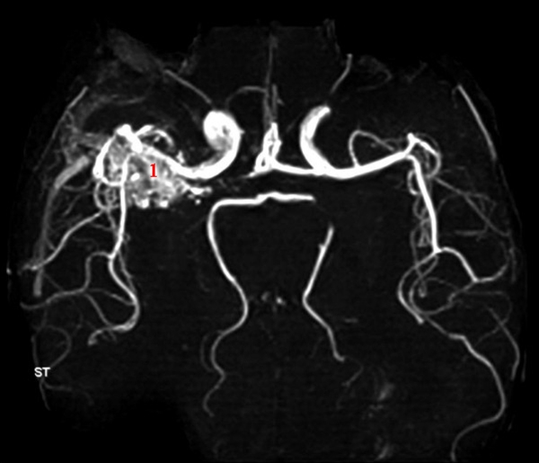 hjerne-AV-malformation-angio-mr