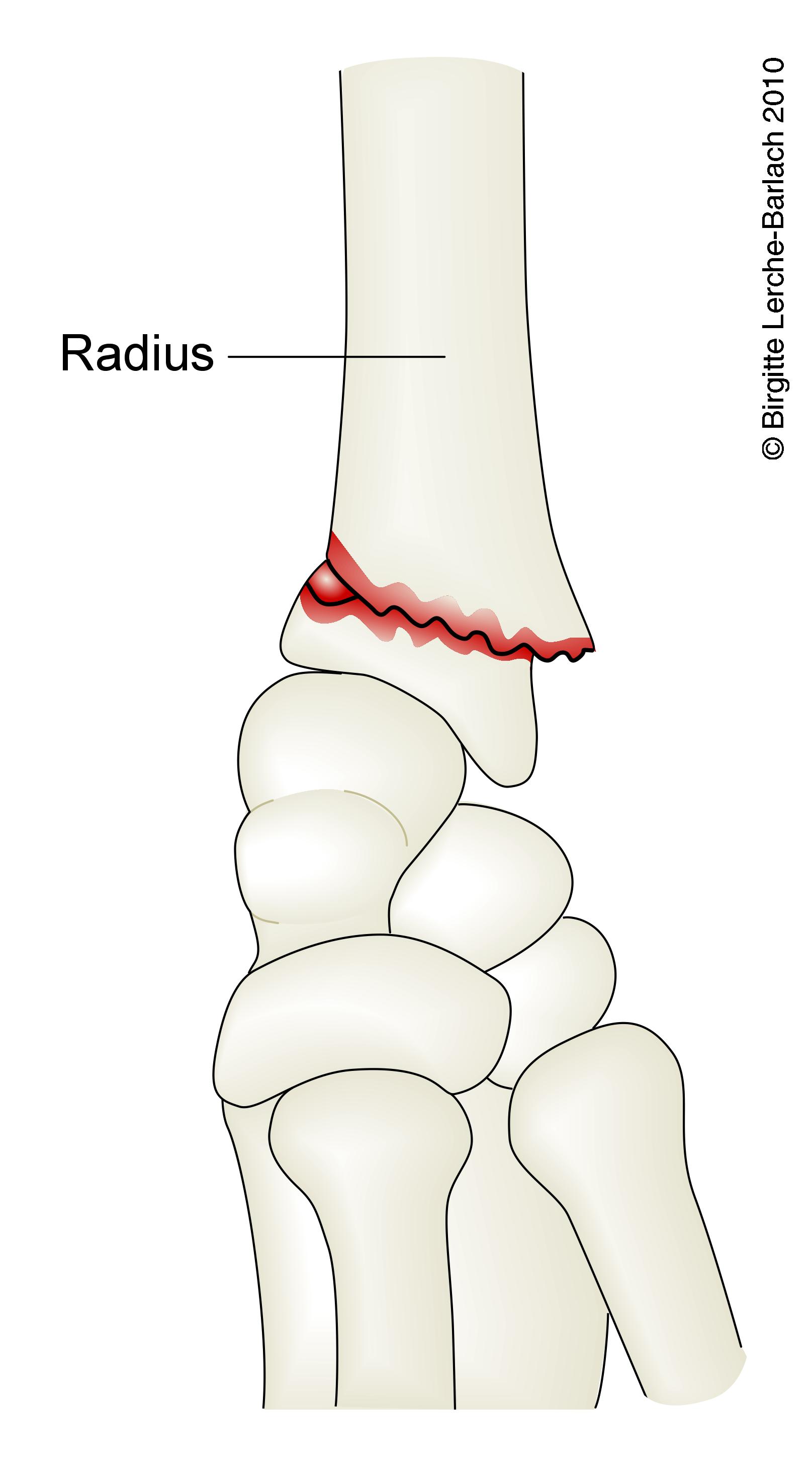 underarm-fraktur radius 7319
