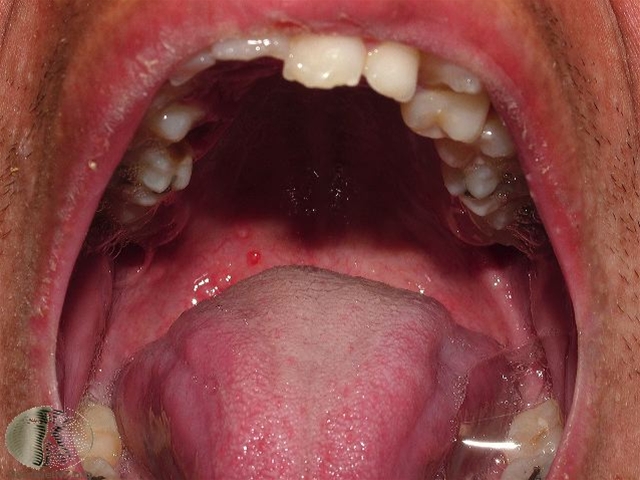 mundhule-skoldkopper