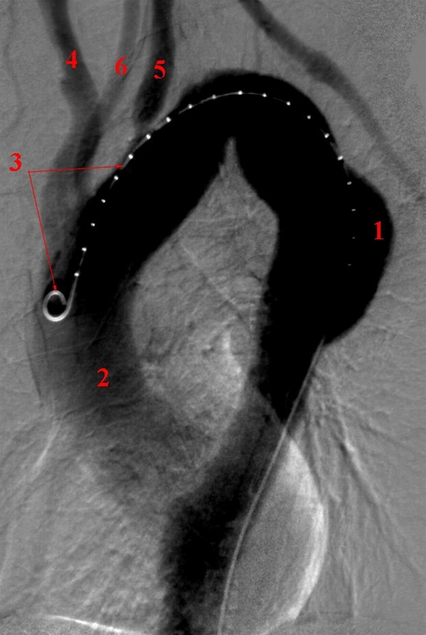 aorta-aneurisme thoracalt-angiografi