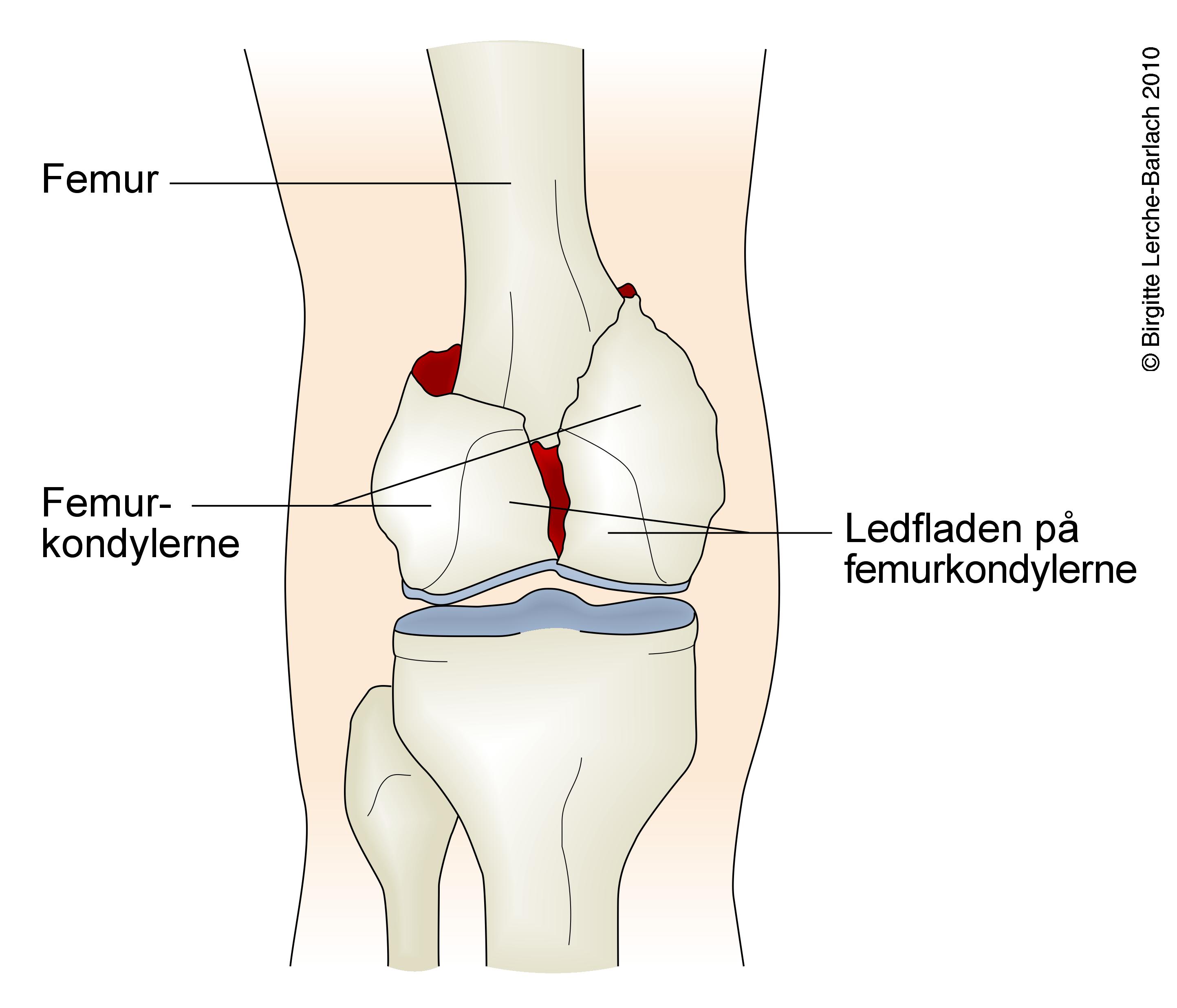 ben-intrakondylaer femurfraktur
