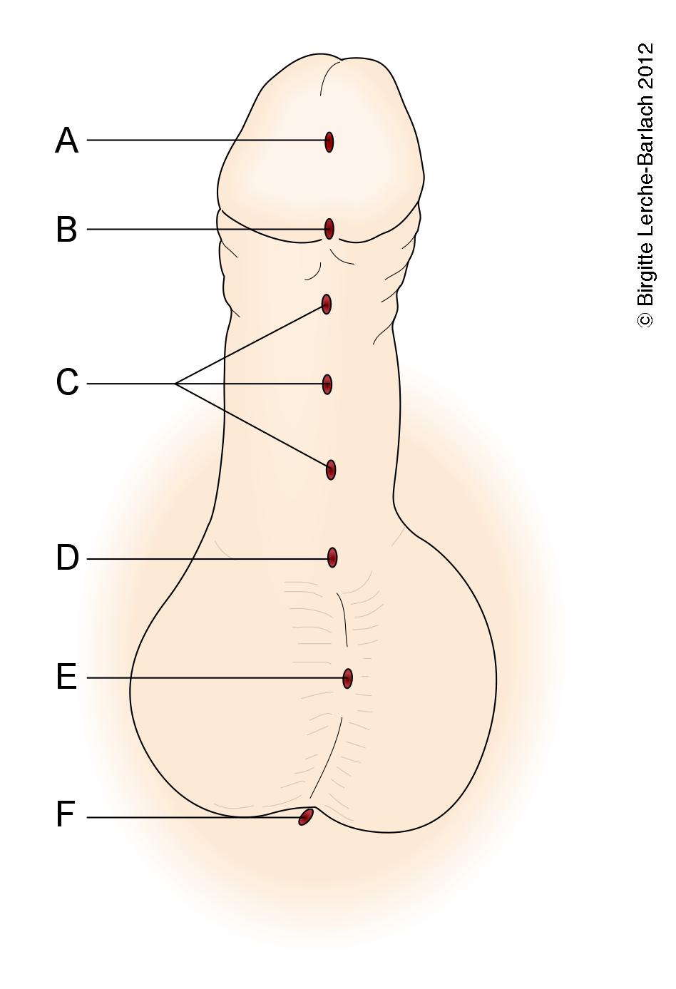 penis-hypospadi