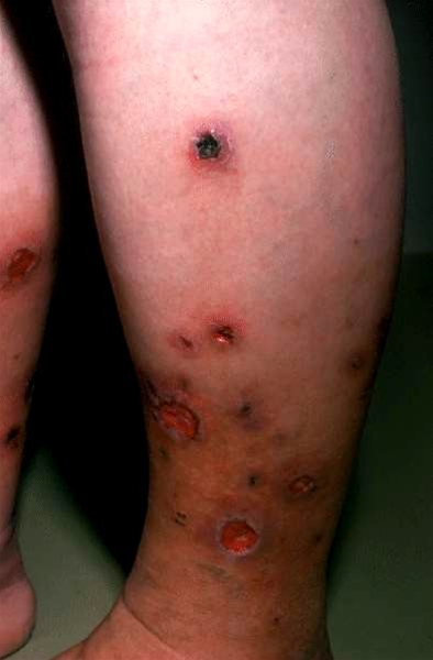 vaskulit allergisk-ben