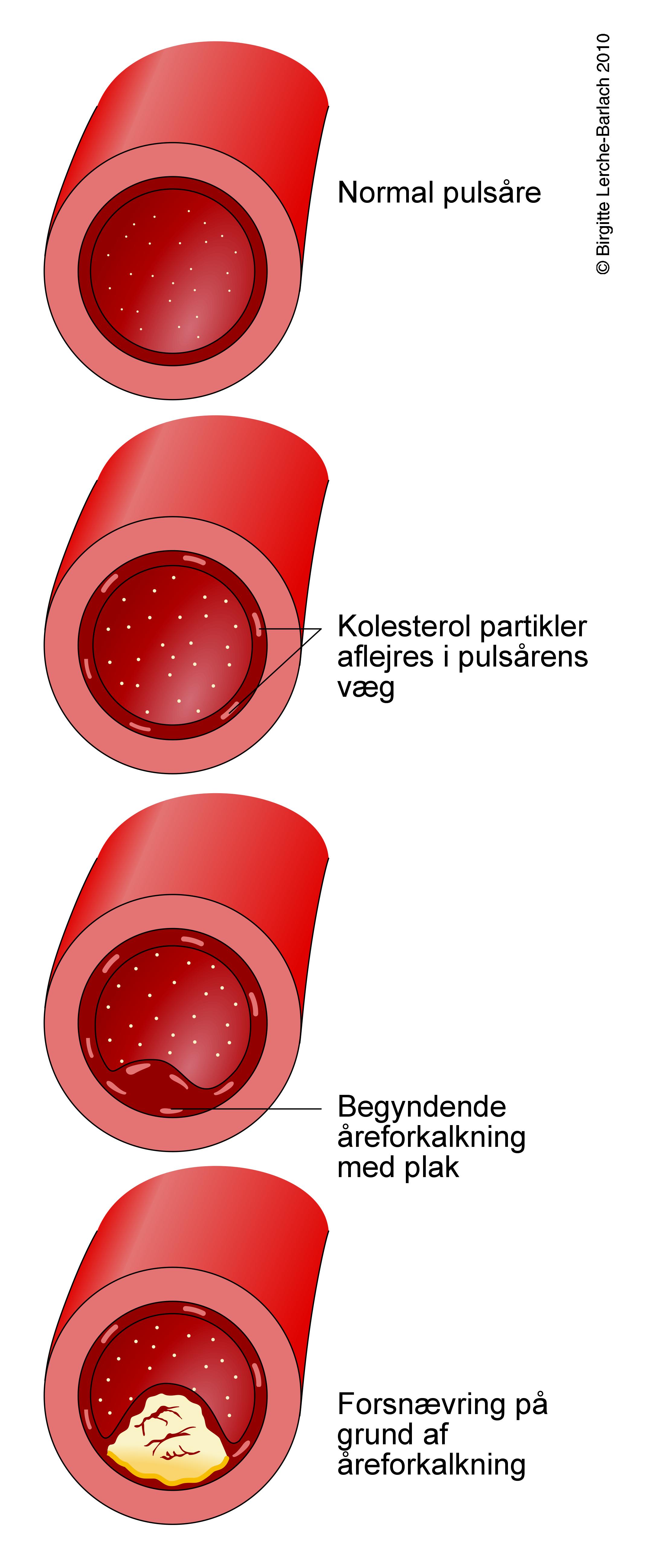 aare-aterosklerose udvikling