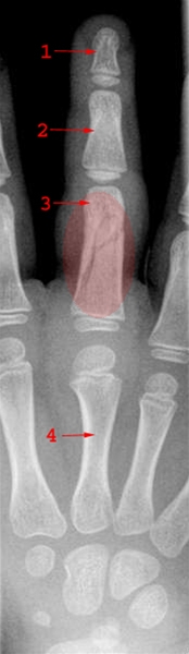 finger-fraktur-rtg frontal