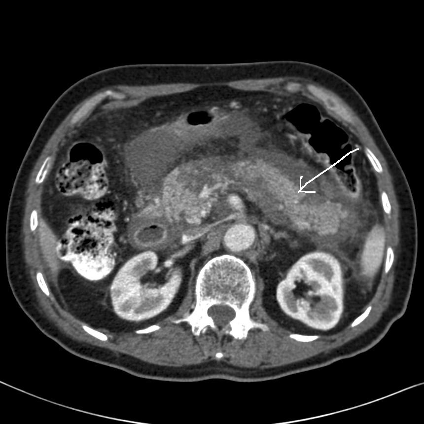 pankreas-nekrotiserende pancreatit-mr