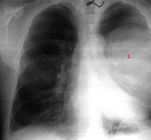lunger-lungeabscess front-roentgen