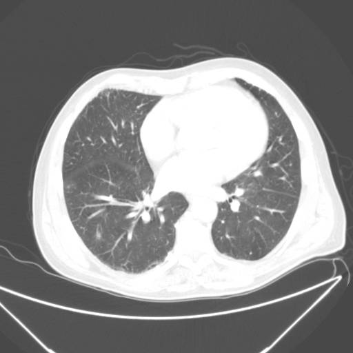 lunger-foer lungebetaendelse-ct
