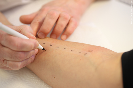 Arm, hvor læge er i gang med at udføre en priktest for allergi.