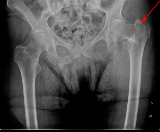 hofter-begge forfra med fraktur-roentgen