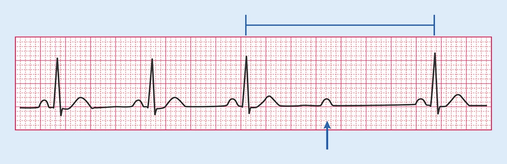 EKG 2 grads AV blok Mobitz type 2