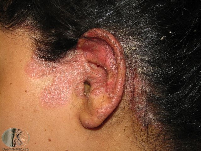 psoriasis hovedbund (1)