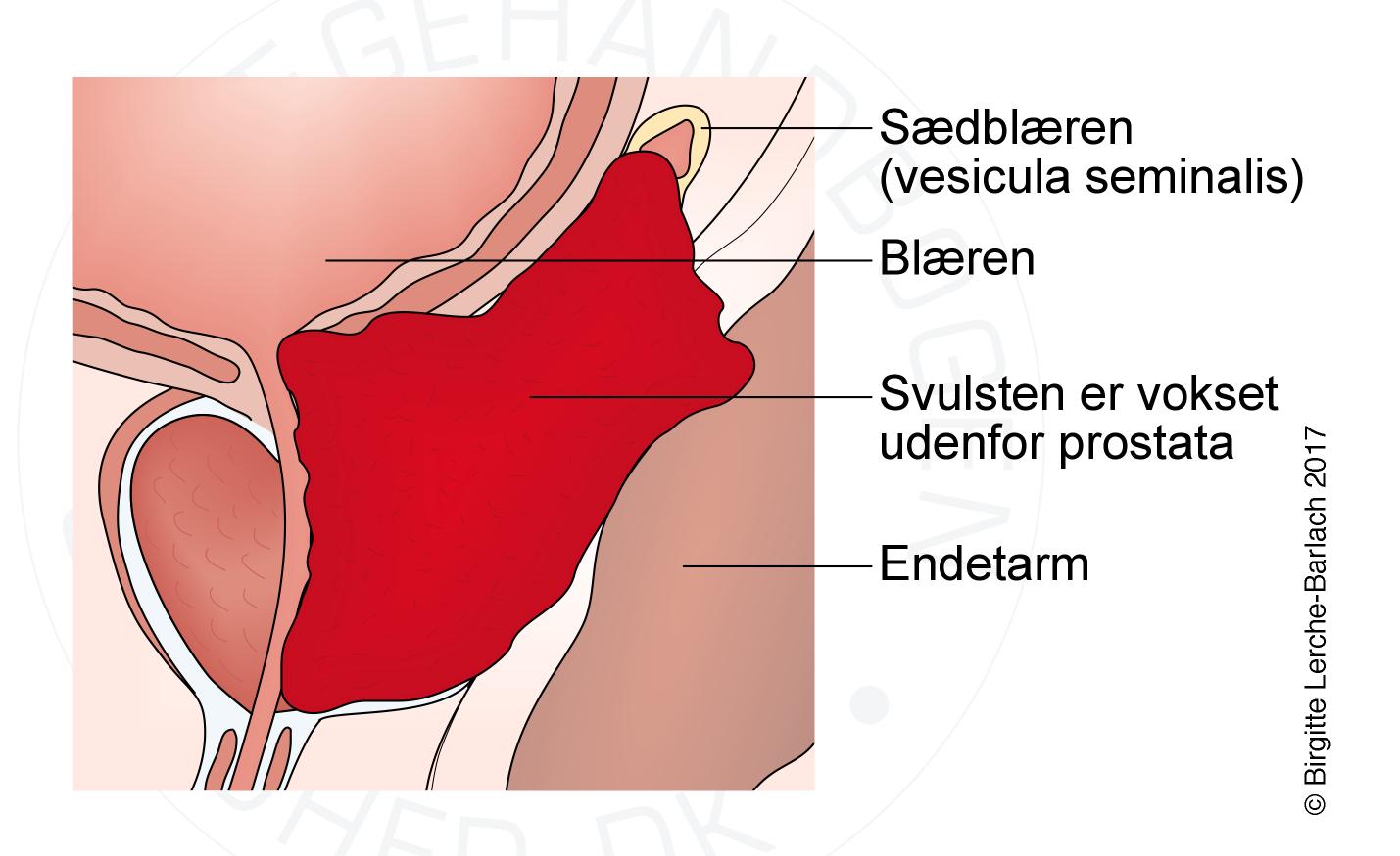 prostata-prostatacancer stadie 4