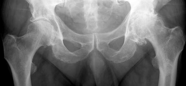 baekken-coxartrose bilateralt-roentgen