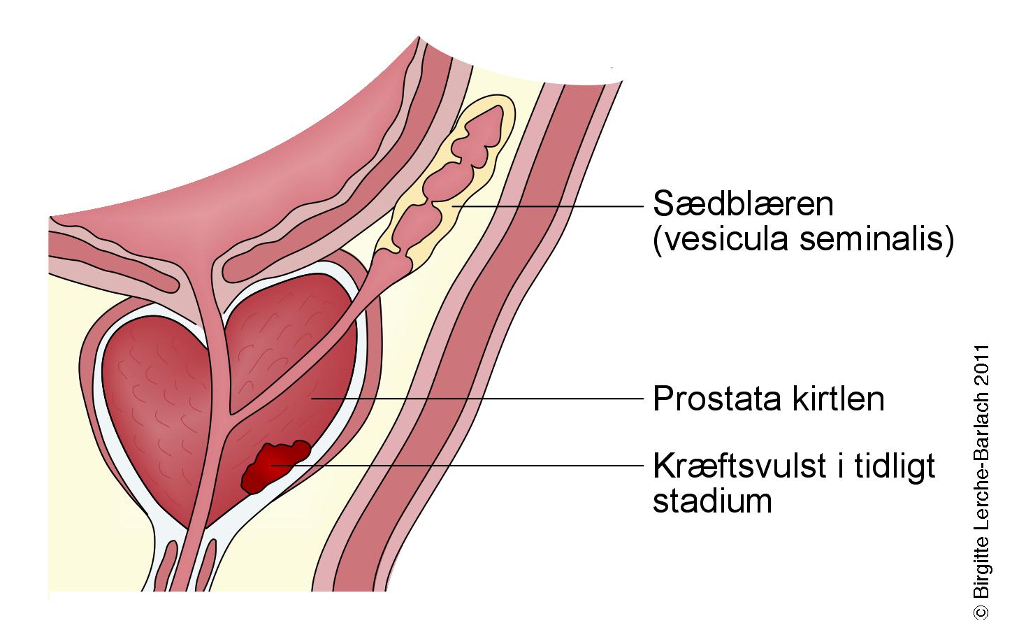 prostata-prostatacancer stadie 1