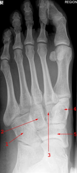 fod-normal-skraa-roentgen