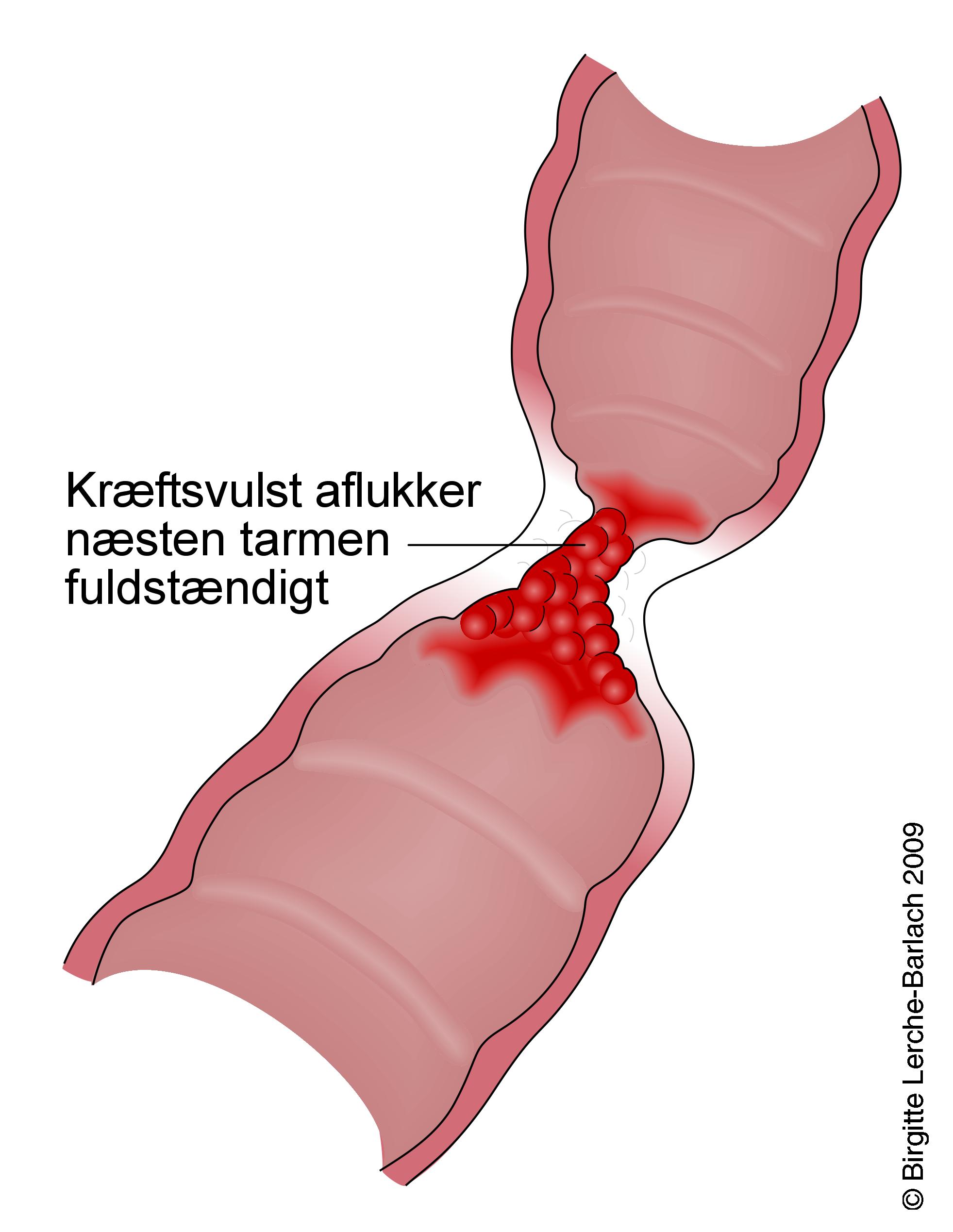 strikturerende cancer i tarm