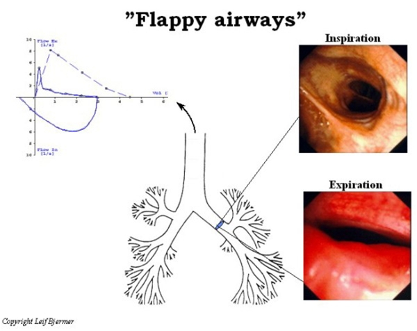 luftveje-flappy airways