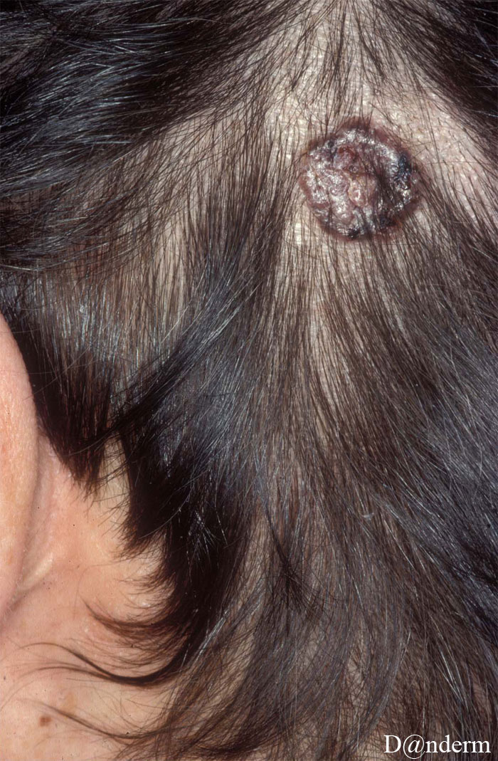 Basalcellecarinom 50407