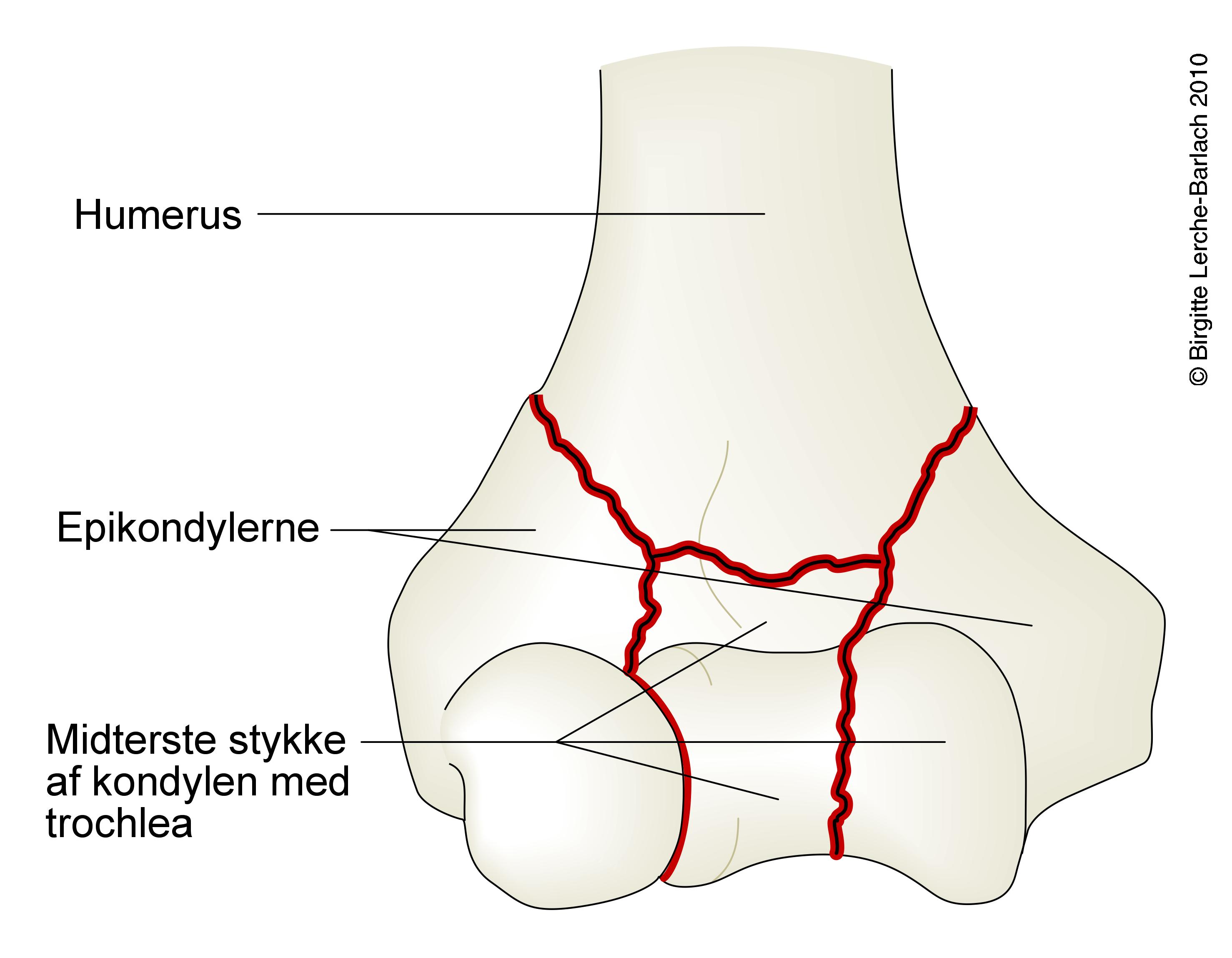 overarm-fraktur transkondylaer komminut humerus 7326